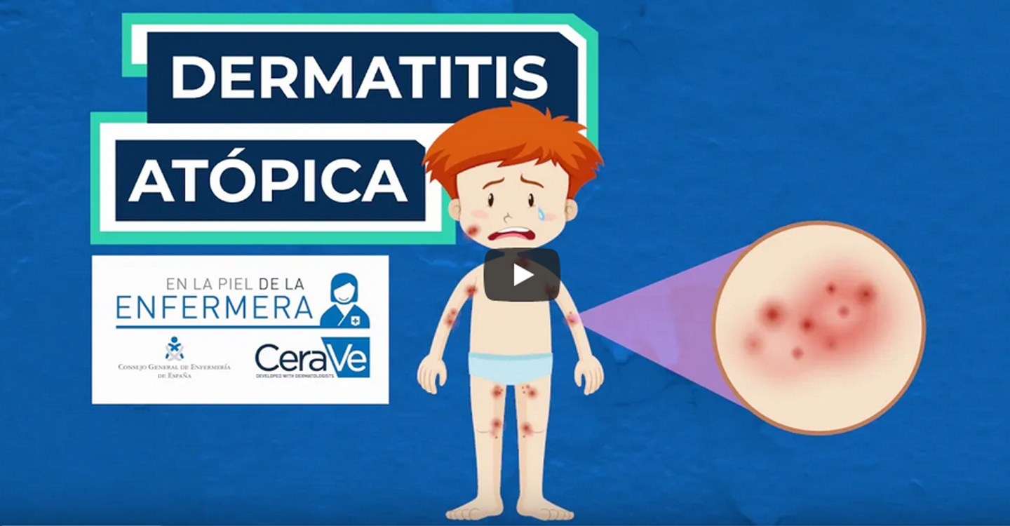 Claves del cuidado de la dermatitis atópica, una enfermedad que afecta a 2 de cada 10 niños y en adultos llega a ser grave