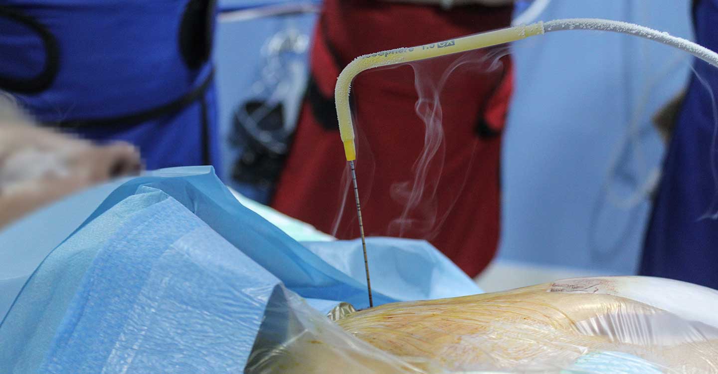 El Hospital de Toledo incorpora una nueva técnica de tratamiento mínimamente invasiva para los nódulos tumorales de pulmón