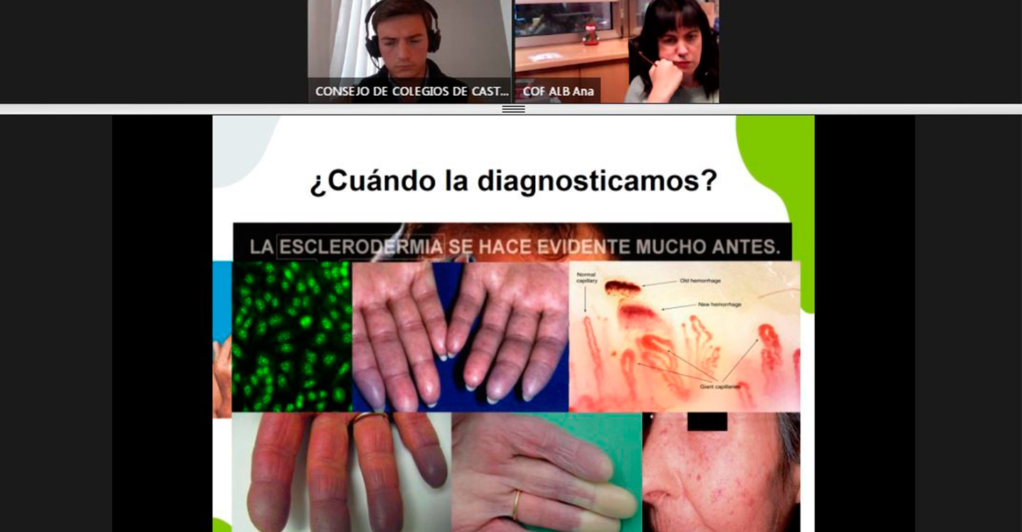 La Asociación Española de Esclerodermia y el COFCAM promueven una charla para la detección precoz de esta enfermedad rara