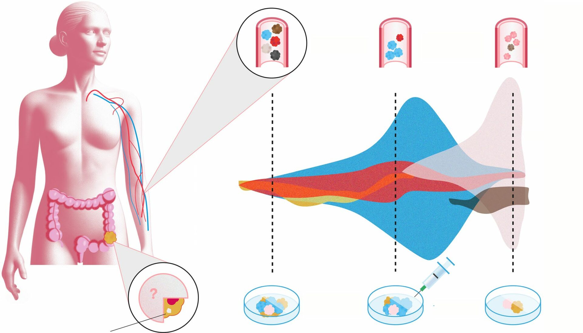 Una investigación pionera mejora la detección de micrometástasis del cáncer de colon mediante un análisis de sangre y abre las puertas a la inmunoterapia en fases tempranas