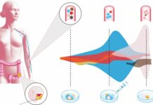 Una investigación pionera mejora la detección de micrometástasis del cáncer de colon mediante un análisis de sangre y abre las puertas a la inmunoterapia en fases tempranas