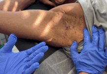 El Hospital público Severo Ochoa trata de forma integral la hidradenitis supurativa mediante ecografía cutánea