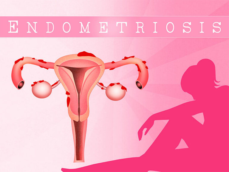 Tomelloso acoge la III charla sobre endometriosis para dar visibilidad a la enfermedad y resolver dudas