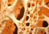 Las enfermeras abordan a través de una guía de casos prácticos la enfermedad silenciosa de la osteoporosis Las enfermeras abordan a través de una guía de casos prácticos la enfermedad silenciosa de la osteoporosis